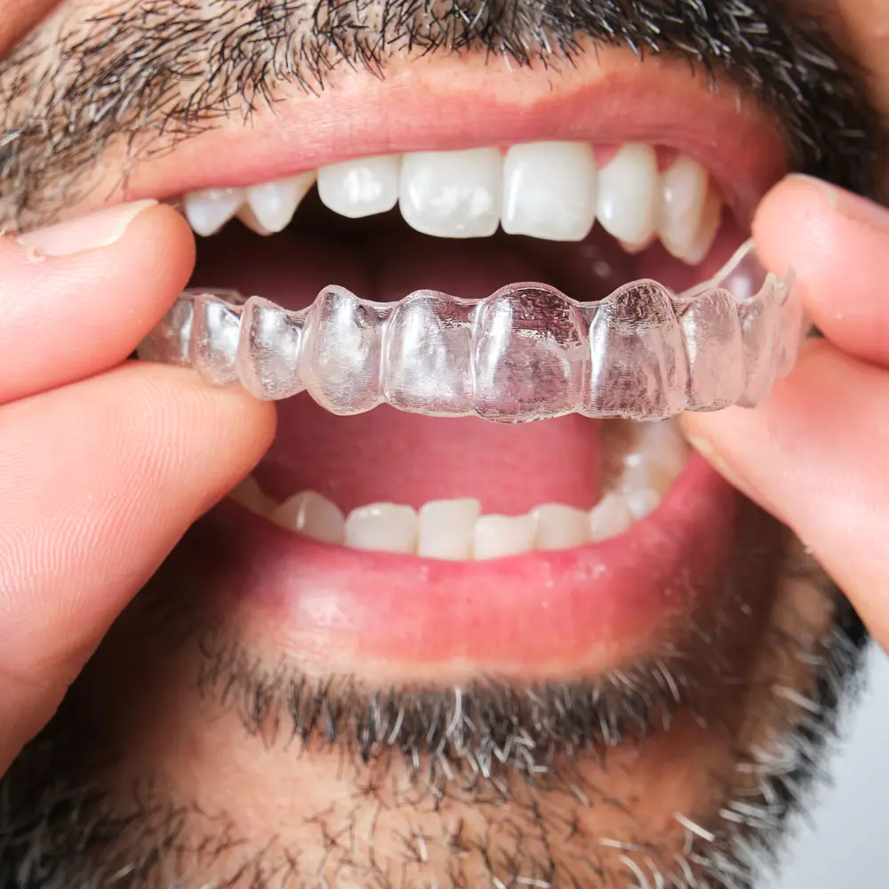 ortodoncia con alineadores transparentes en mym dental