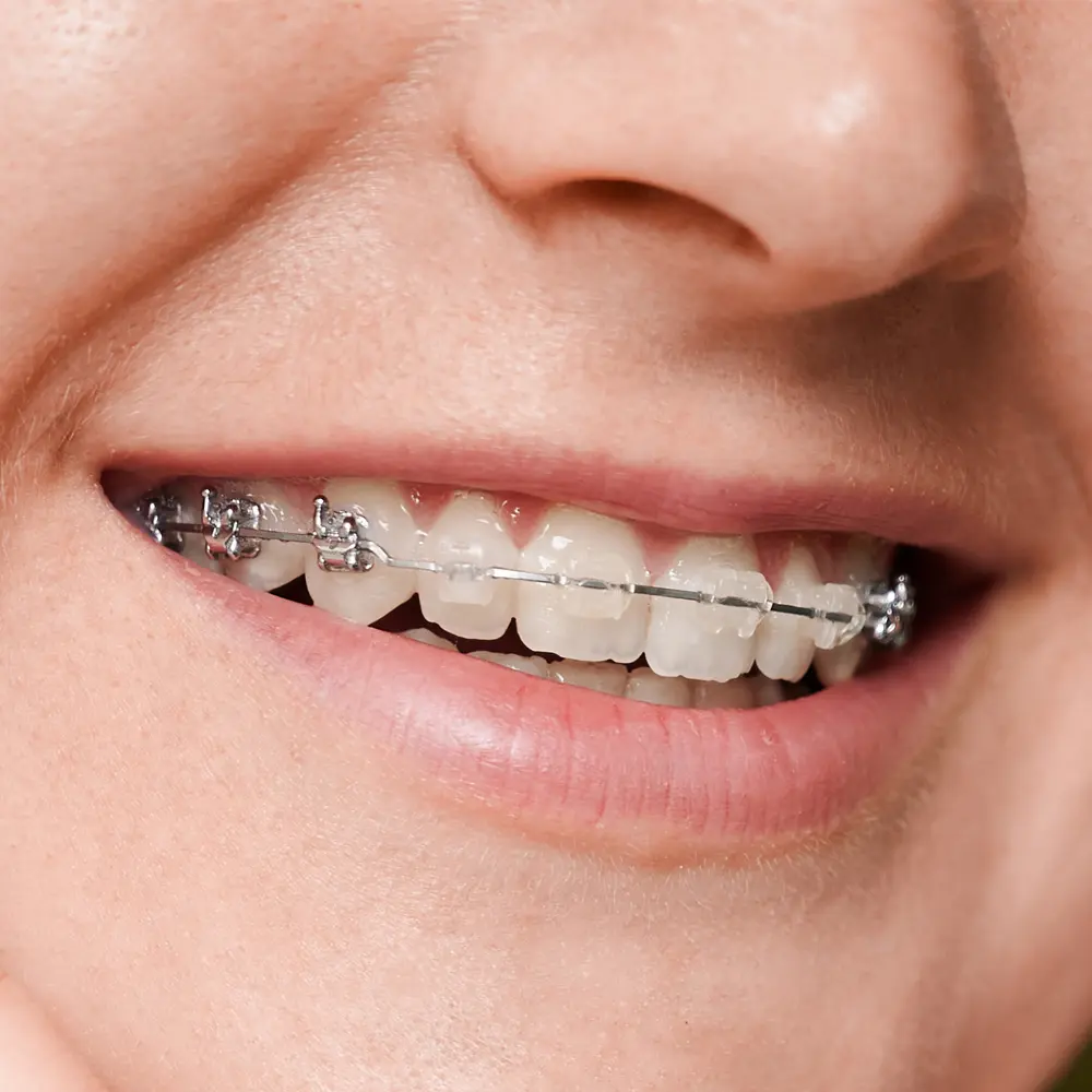 ortodoncia con brackets estéticos en mym dental