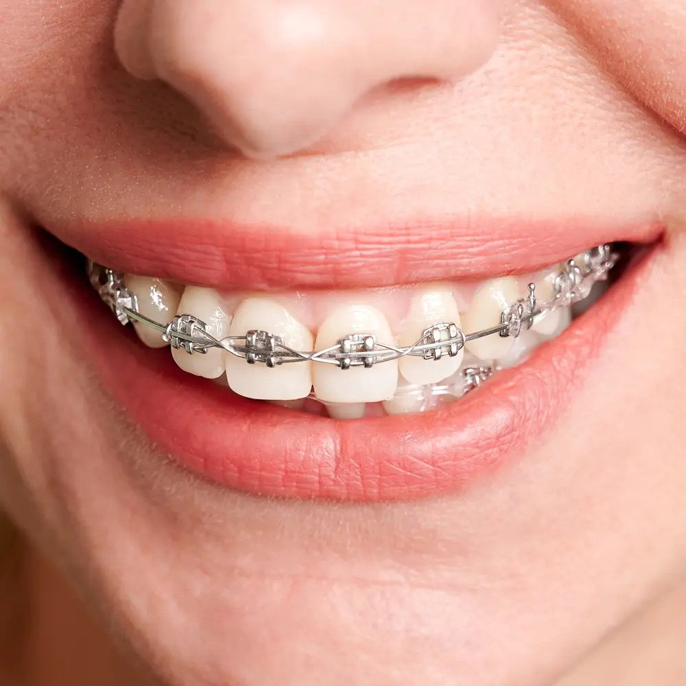 ortodoncia con brackets metálicos en mym dental