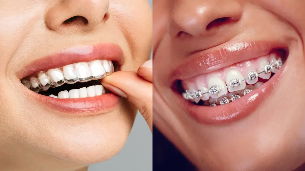 brackets y alineadores profesional cuidado dental